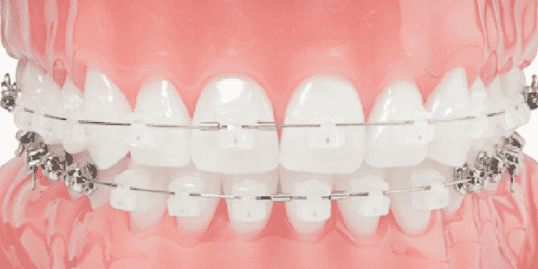 Aparat ortodontyczny - zamki estatyczne samoligaturujące