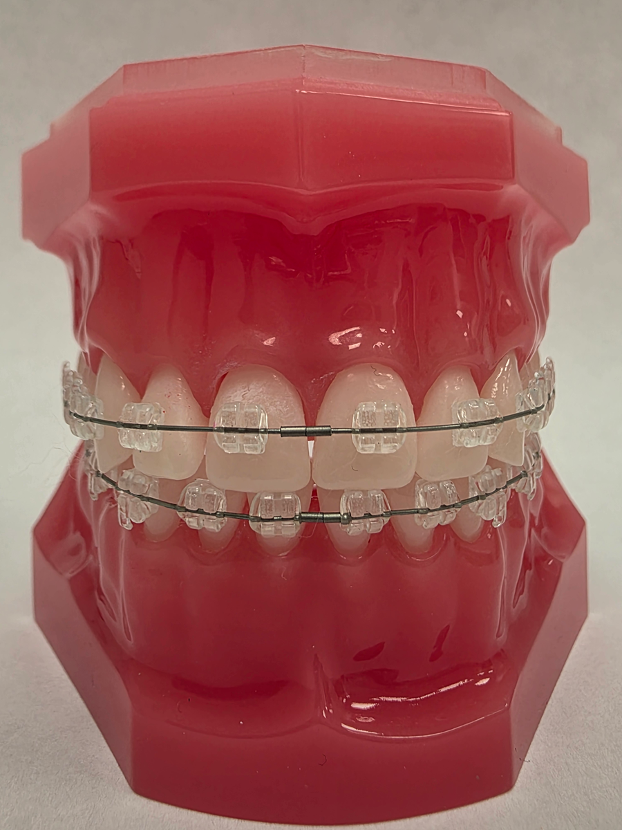 Aparat ortodontyczny - zamki estetyczne szafirowe