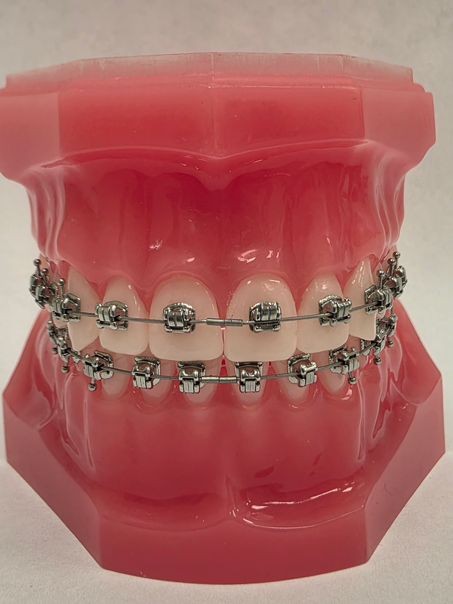 Aparat ortodontyczny - zamki metalowe samoligaturujące