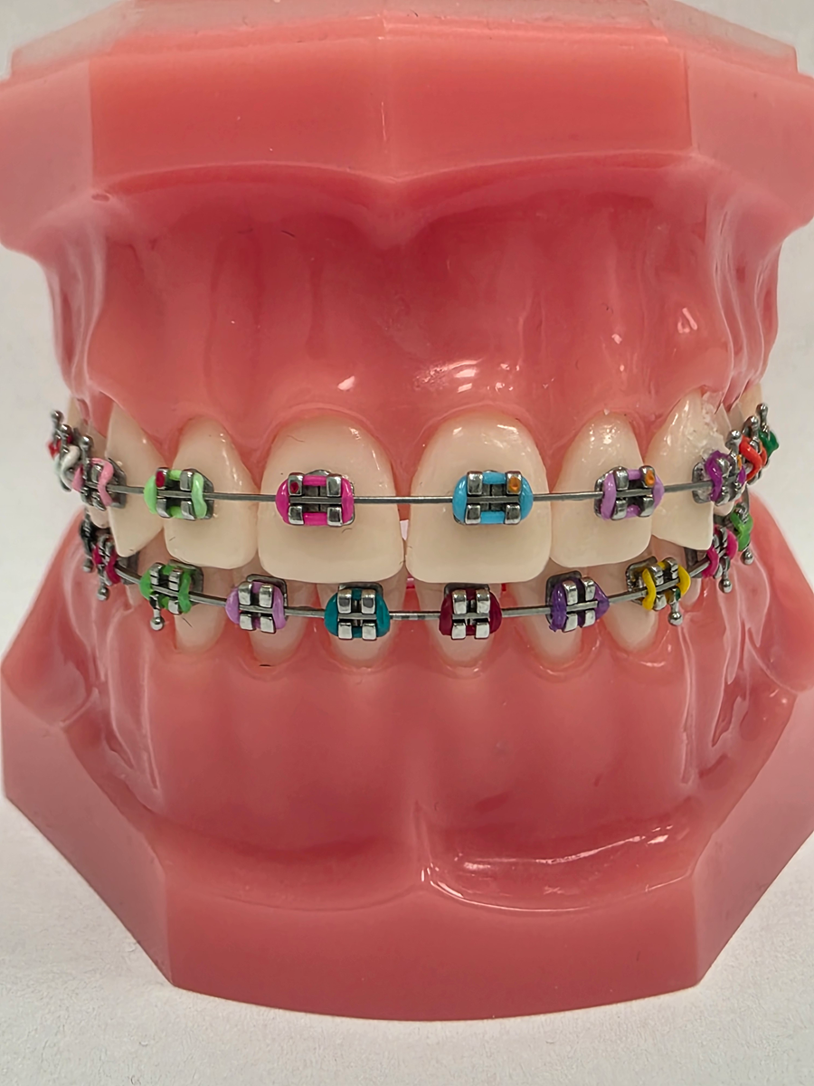 Aparat ortodontyczny - zamki metalowe