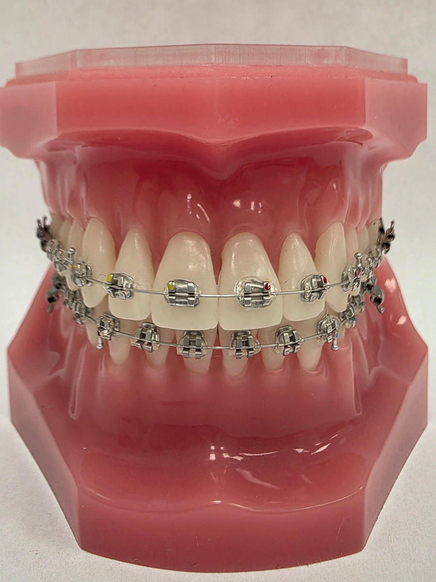 Aparat ortodontyczny - zamki rodowane